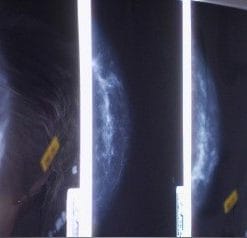 Breast Biopsy – Ultrasound, Stereotaxis & MRI Guidance 2013 (CME Videos)
