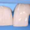 Direct and Indirect Adhesive Restorations