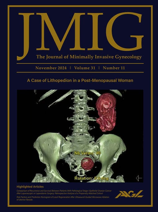 Journal of Minimally Invasive Gynecology PDF