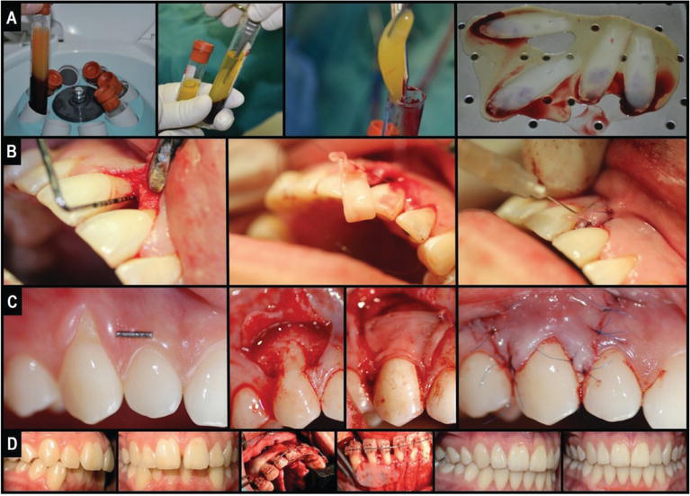 7 Advanced Applications of PRF in OHI-S Regenerative Dentistry: A 2024 Guide