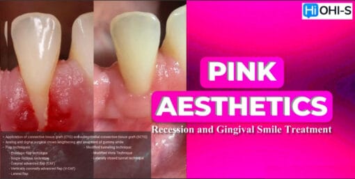 OHI-S Pink Aesthetics, Recession and Gingival Smile Treatment