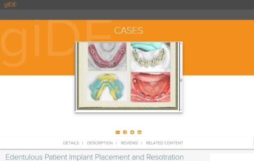 gIDE ondemand lectures – Edentulous Patient Implant Placement and Restoration