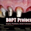 OHI-S BOPT Protocols Surgery, Prosthetics, Dental Technician Stage