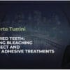 Discolored teeth: combining bleaching with direct and indirect adhesive treatments