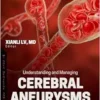 Understanding and Managing Cerebral Aneurysms (PDF)